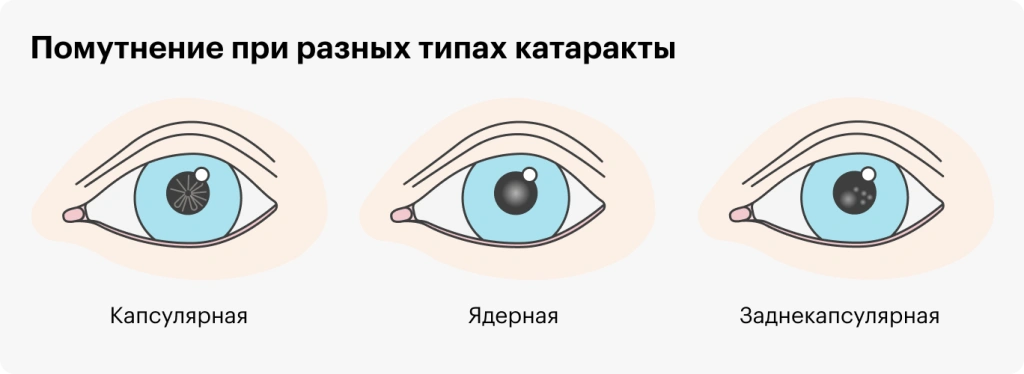 Катаракта и витрэктомия